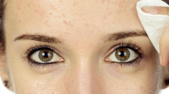Acne comedonica e comedoni chiusi