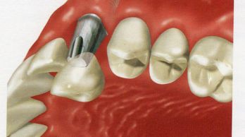 Implantologia a carico immediato: che cos’è?