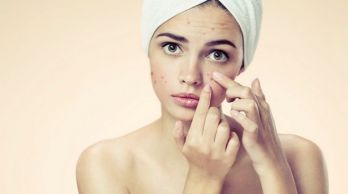 L’ acne giovanile : rimedi e cause