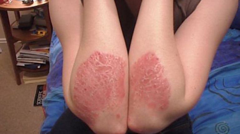 Crema per psoriasi a cosa serve?
