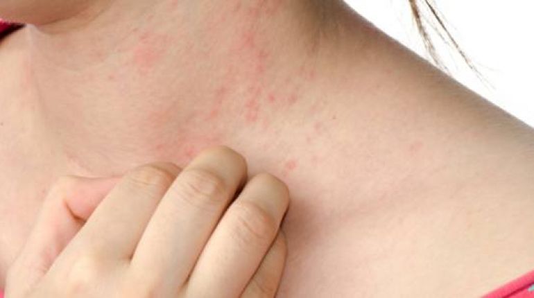 Psoriasi cause