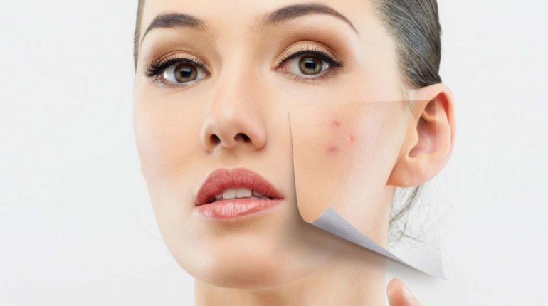 Triacneal dell’ Avene per le pelli con brufoli e acne