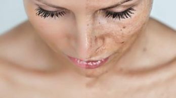 Crema per macchie viso come agisce?